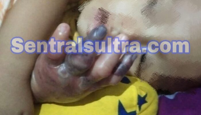 Tangan Balita Diduga Melepuh dan Bernanah Usai Diinfus, Keluarga Keluhkan Pelayanan RS Bhayangkara Kendari